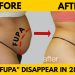 What is FUPA? | How to Get Rid of FUPA?